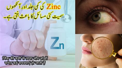 Zinc Deficiency Causes Many Problems Including Skin And Eyes Youtube