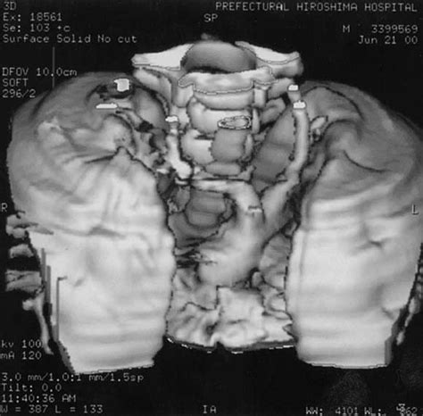 Spiral Computed Tomography And Three Dimensional Image Reconstruction