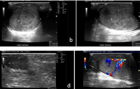 Shows Scrotal Ultrasound Image Of 31 Years There Is Well Defined Download Scientific Diagram