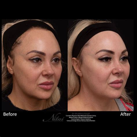 Potenza Rf Microneedling Melbourne Nitai Cosmetic Centre