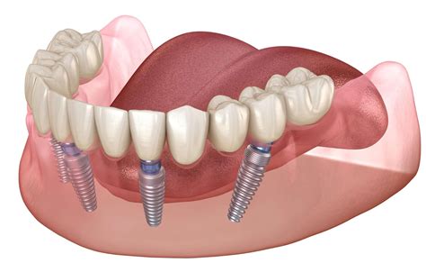 The Ultimate Guide To Dental Implants Dental Implants Midtown Manhattan