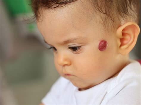 Hemangioma Infantil Entenda o que Causa Esse Tipo de Lesão