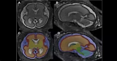 In Fetuses Exposed To Alcohol MRI Reveals Altered Brain Structure QS