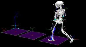 Gait Analysis Hmg Physio Clinic Waltham Abbey