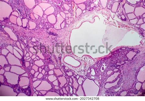 Endemic Goiter Light Micrograph Abnormal Enlargement Stock Photo