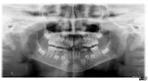 Tooth, Supernumerary; Molar, Fourth