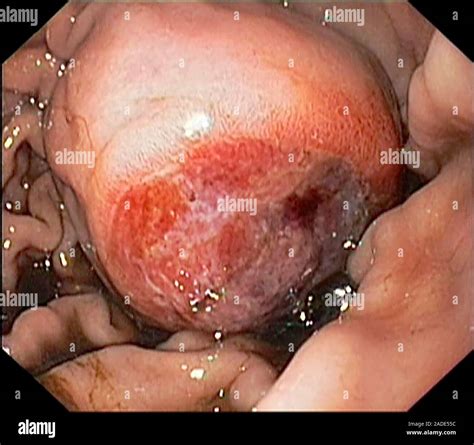 Tumor Del Estroma Gastrointestinal Vista Endoscópica Ulcerada De Tumor Del Estroma