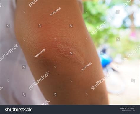 Keloid Scar Hypertrophic Scar Elbow Skin Foto De Stock Editar Ahora