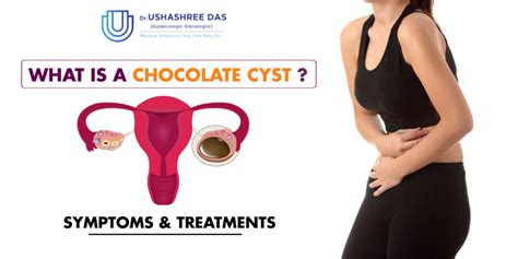 What Is A Chocolate Cyst, Symptoms & Treatments?