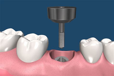 Dental Implant Procedures