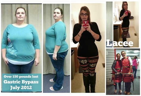Gastric Sleeve