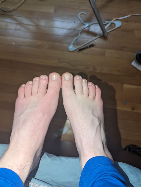 Ingrown Toenails