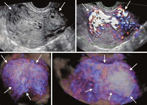 A To D Chemosensitive Invasive Mole The Use Of Transvaginal Download Scientific Diagram