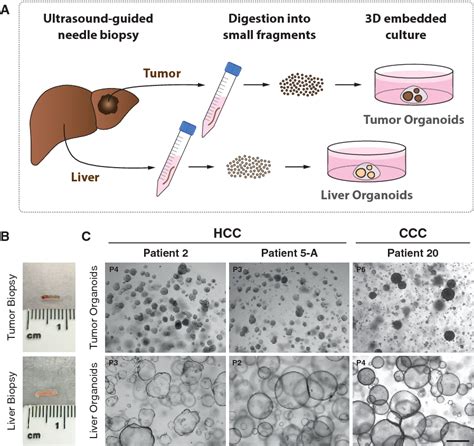 Figure 1 From Organoid Models Of Human Liver Cancers Derived From Tumor Needle Biopsies