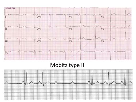 Ppt Understanding Ecg With Dr Sara Detailed P Wave And Pr Interval