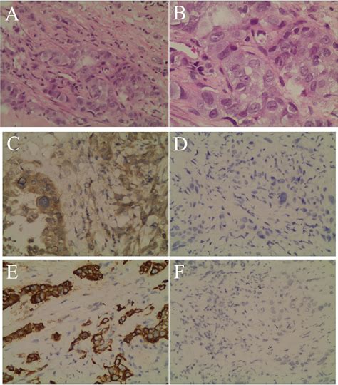 Frontiers Hepatoid Adenocarcinoma Of The Lung A Systematic Review Of