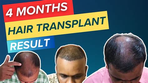 My 4 Months Hair Transplant Result Timeline Getting Natural Hairline