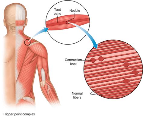 Benefits Of Dry Needling