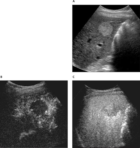 Diagnosis Of Focal Liver Masses On Ultrasonography Wilson 2007