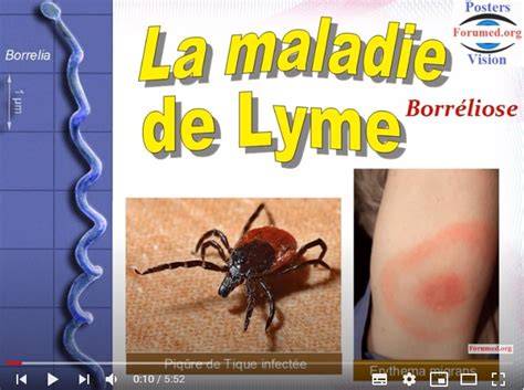 Maladie Lyme Symptômes Diagnostic Traitement Santé Médecine