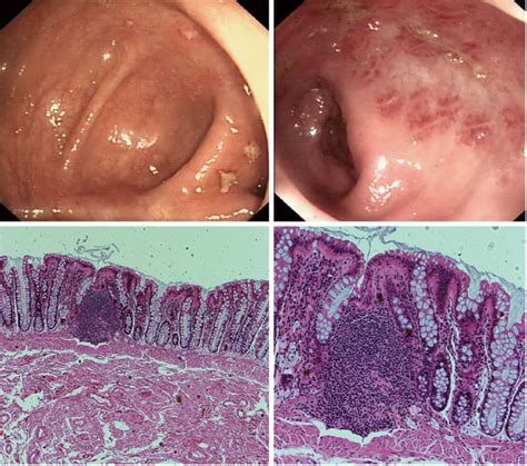 Endoscopic Imaging And Corresponding Histological Findings In Solitary Download Scientific