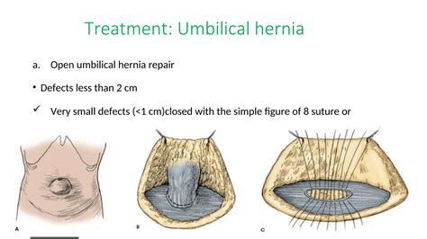 ventral hernia abdominal wall reconstruction awr surgery repair