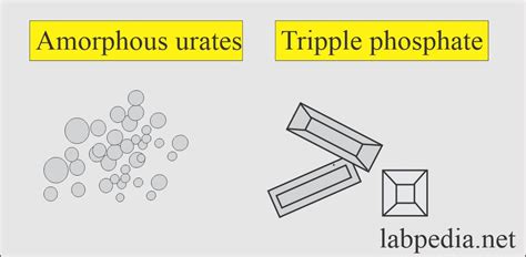 Urine Crystals (Crystalluria) - Labpedia.net