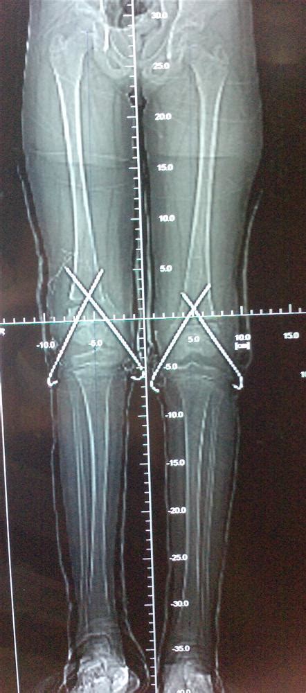 Genu Valgum (knocked knees) - Pediatrics - Orthobullets