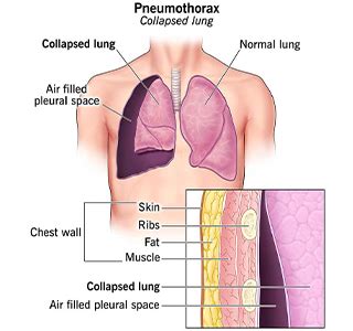 how to fix a collapsed lung