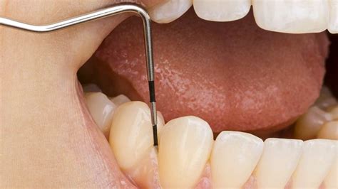 Periodoncia Clínica dental Villadehesa