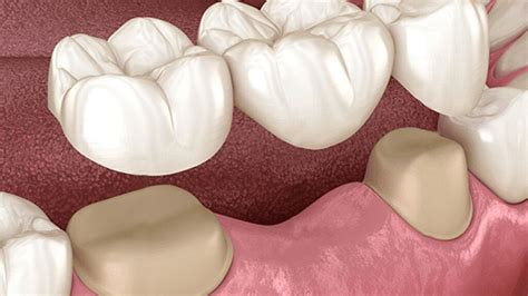 Dental Bridges Vs. Partial Dentures - Pros & Cons | Smiles Toothache ...