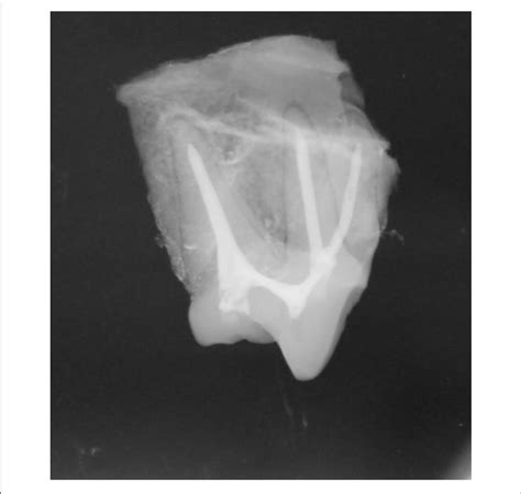 | Radiographic example of acceptable root canal obturation. | Download Scientific Diagram