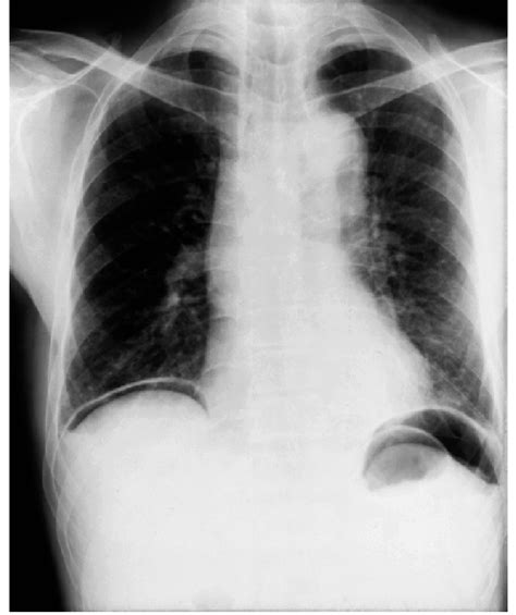 Chest Radiography At The Emergency Admission Revealed Free Air Below Download Scientific