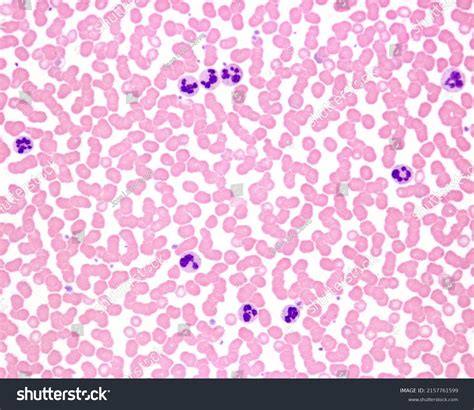 Human Blood Smear Leukocytosis Acute Infection Stock Photo 2157761599 ...