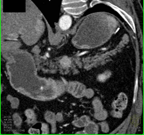 Duodenal Carcinoma And Incidental Neuroendocrine Tumor In The Body Of