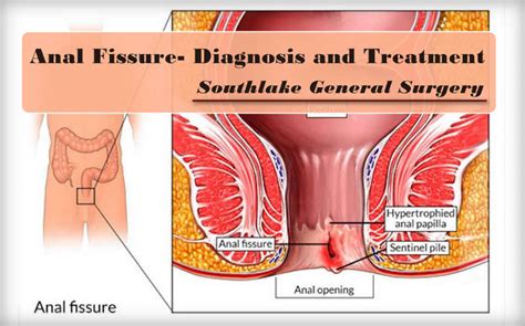 Anal Fissure Symptoms Diagnosis Treatment Southlake General Surgery