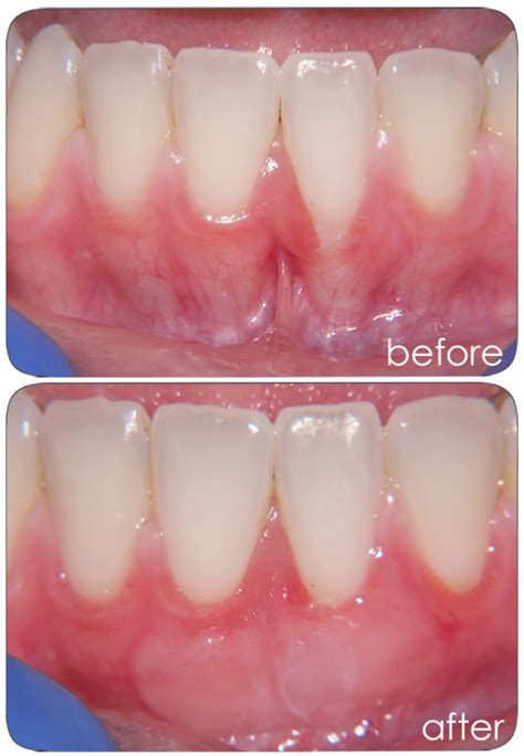 Free Gingival Graft | Lake Charles, LA | Raymond J. Steiner, DDS