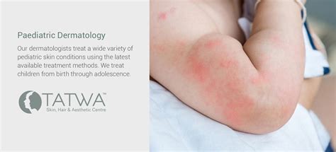 Paediatric Dermatology – Tatwa Skin Clinic