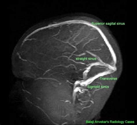 Dr Balaji Anvekar Frcr Normal Mr Venogram Of Brain