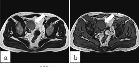 Figure From A Case Of Retroperitoneal Pelvic Castleman Disease