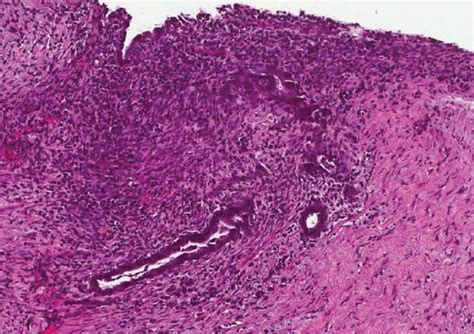 Microscopic Examination Of The Peritoneum Revealed Benign Endometrial