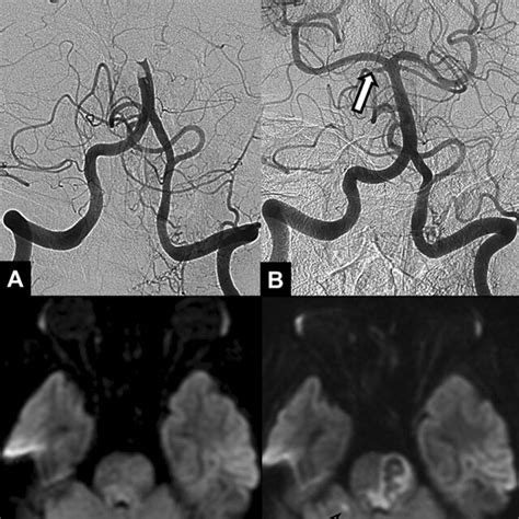 A 64-year-old female patient with acute stroke due to basilar artery ...