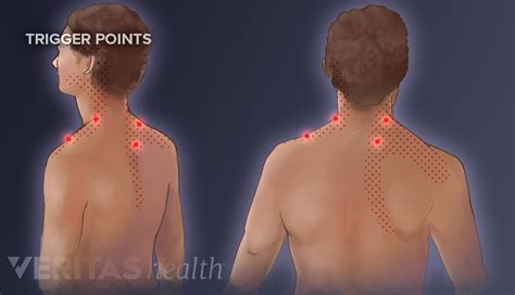 Cervical Osteophytes Treatment Options Spine Health