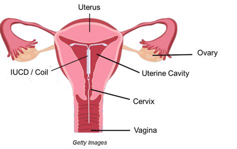 Intrauterine contraceptive device (IUCD) or ‘coil’ insertion at ...