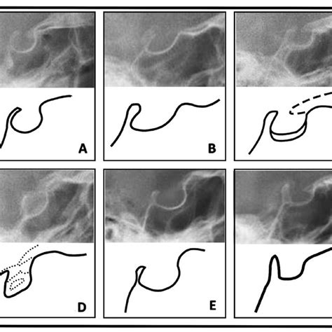 The different shapes of sella turcica: (a) normal sella turcica, (b)... | Download Scientific ...