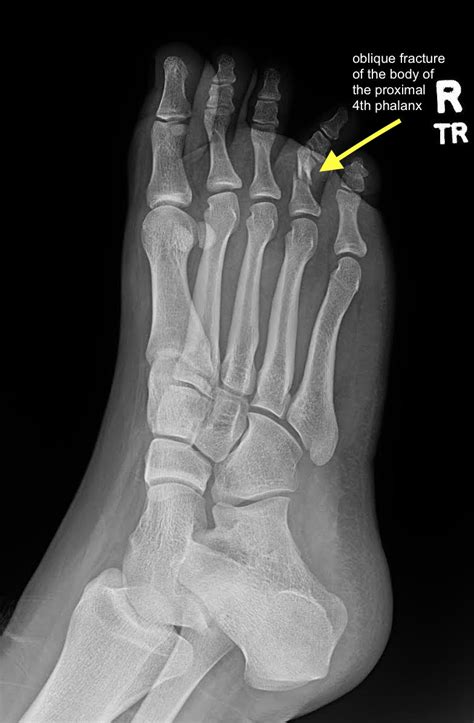 Proximal Phalanx Fracture of the Foot. XRay Prereduction, Annotated ...