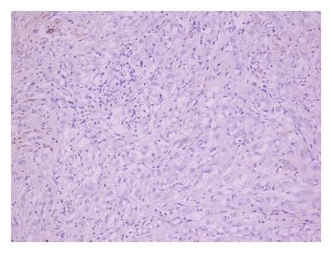 Immunostaining Of Adenomatoid Tumors A Calretinin B