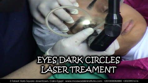 EYES DARK CIRCLES LASER TREATMENT.Q SWITCHED – Moawad Skin Institute (MSI)