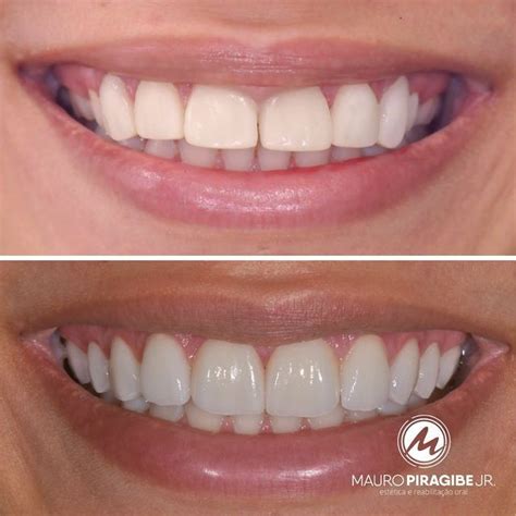 Lente De Contato Dental On Instagram Est A O Antes E Depois Do