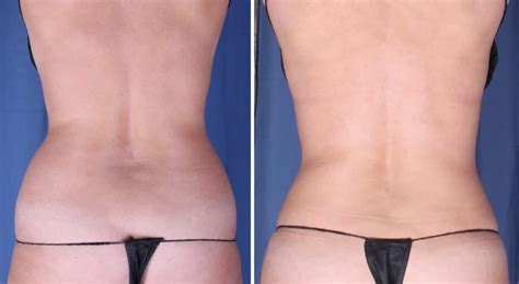 Liposuction In Omaha NE Omaha Liposuction By Imagen